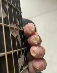 Mal aux doigts à la guitare : pourquoi, combien de temps, et comment soulager